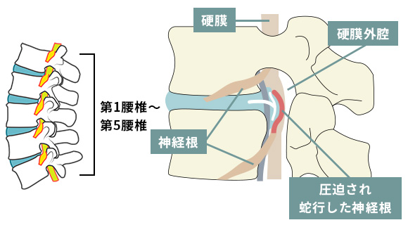 神経根と硬膜外腔