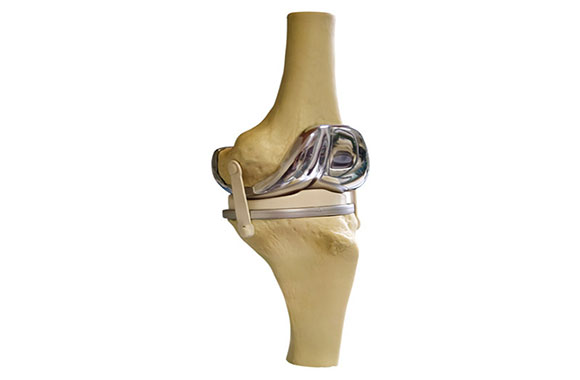 人工関節置換術(膝)