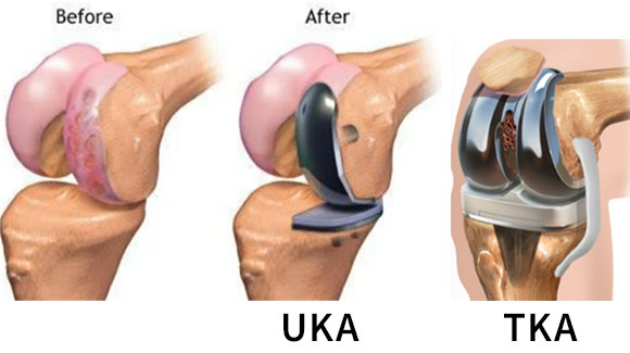 人工関節置換術(膝)