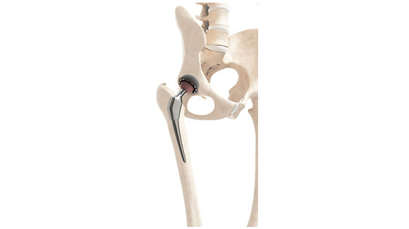 人工関節置換術(股)