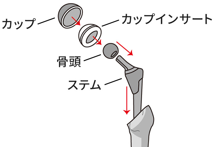 人工股関節手術とは