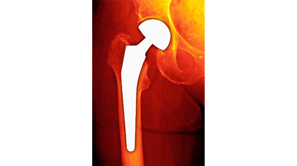 人工骨頭挿入術