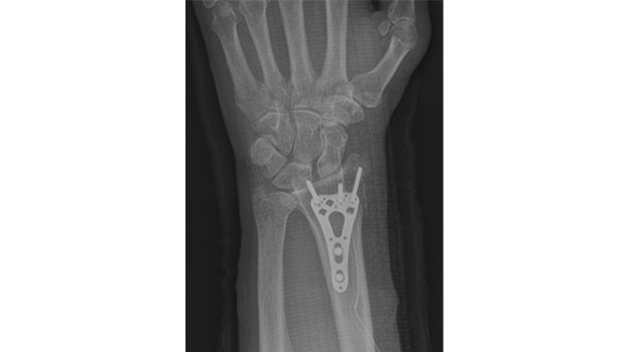 骨折手術(前腕)