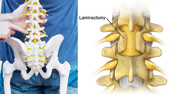 椎弓切除・椎弓形成術
