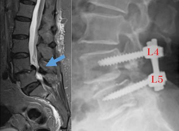 後方椎体固定術