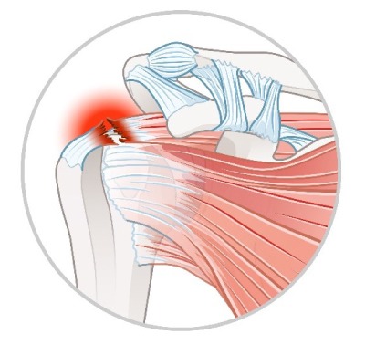 関節鏡下肩腱板断裂手術