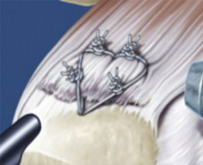 関節鏡下肩腱板断裂手術