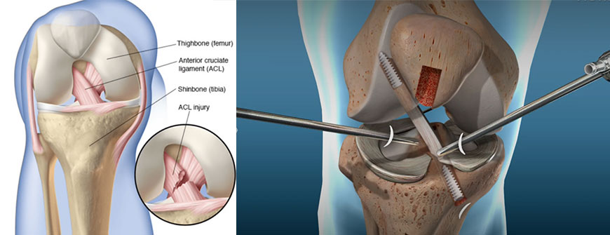 関節鏡下靭帯断裂形成手術