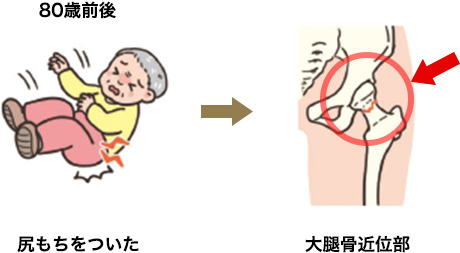 転んで脚が痛くて起きれない（大腿骨近位部骨折）