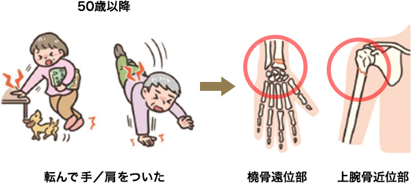 転んで手をついたら手がパンパンに腫れている（橈骨遠位端骨折）  腕が上がらなくなった（上腕骨近位部骨折）