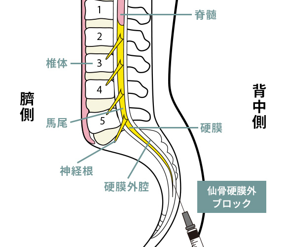 仙骨硬膜外ブロックとは