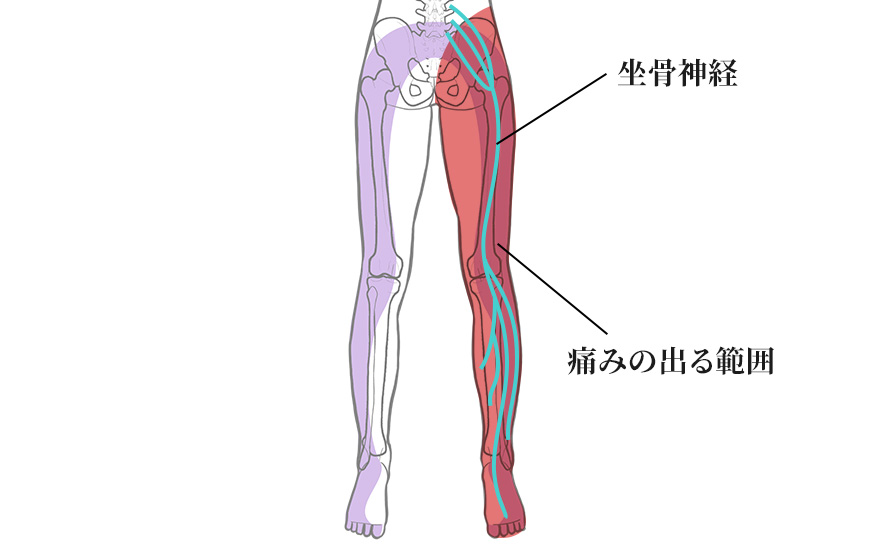 坐骨神経痛とは