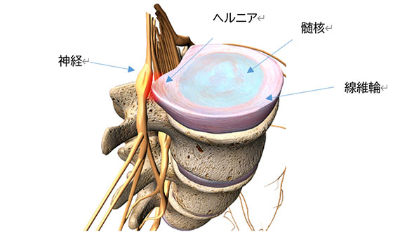 腰椎椎間板ヘルニア