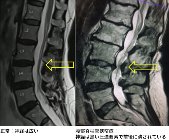 腰部脊柱管狭窄症