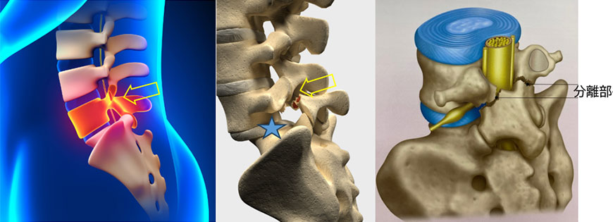 腰痛分離すべり症