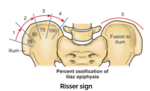 Risser signの分類