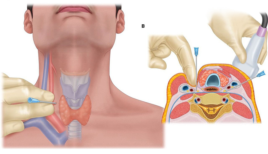 消毒と注射の実施