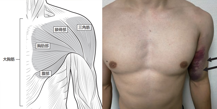 ベンチプレスでの肩疼痛