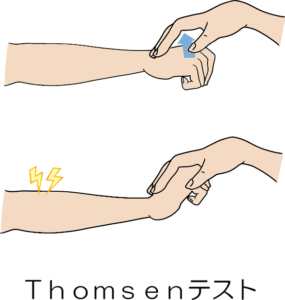 Thomsenテスト