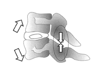 椎間関節の衝突（〇）